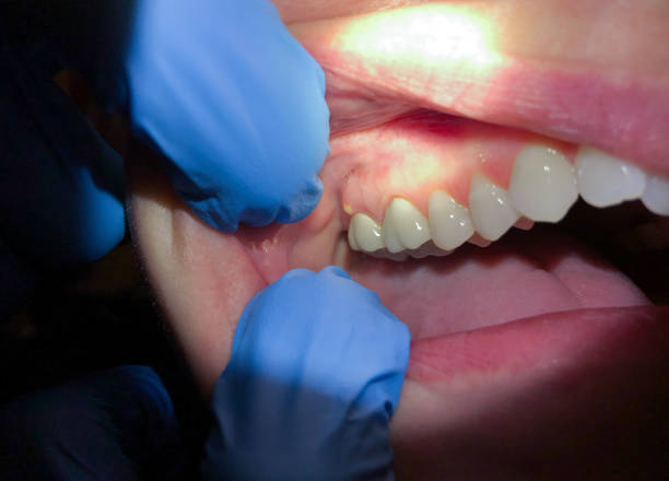 Best Broken or Chipped Tooth Repair in Springfield, VA