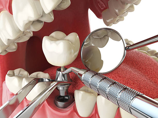 Best Dental Abscess Treatment in Springfield, VA